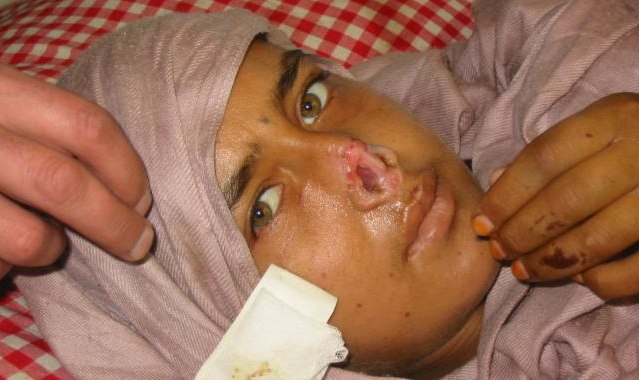 example-of-muslim-woman-with-nose-cut-off